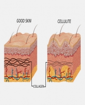سلولیت پوستی چیست؟